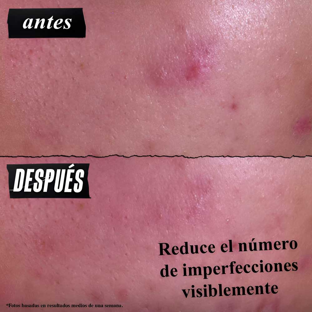 Acné adulto hormonal: cómo tratarlo sin sobrecargar la piel